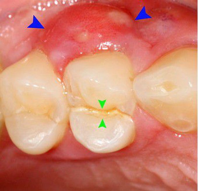 Cracked tooth syndrome