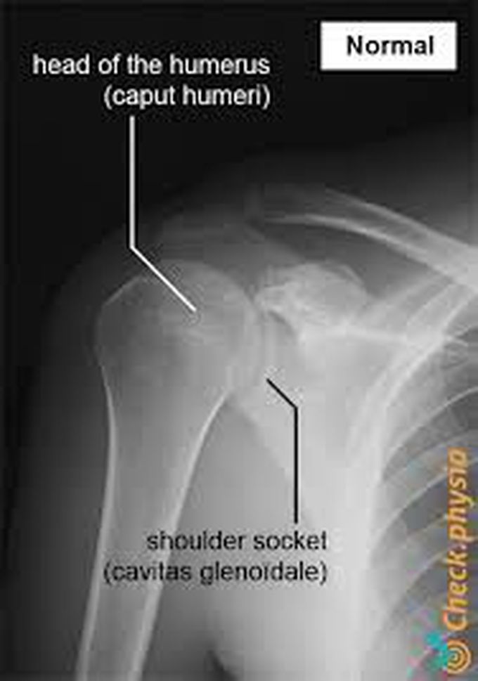 what causes joint subluxation