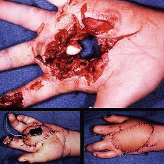Traumatic injury