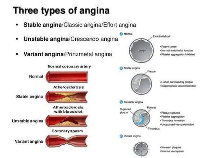 Look at lumen of blood vessel :narrowing and spasm