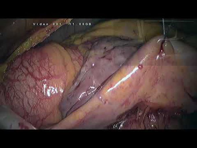 Isolated Endoscopic Tricuspid Valve Surgery