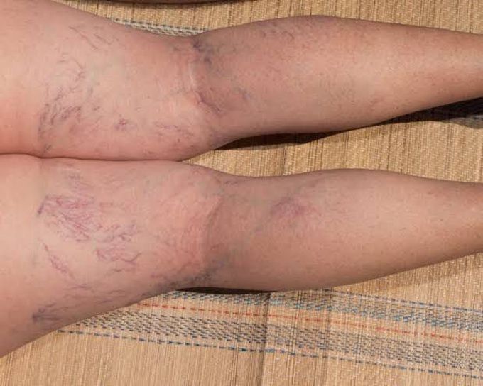 Varicose veins