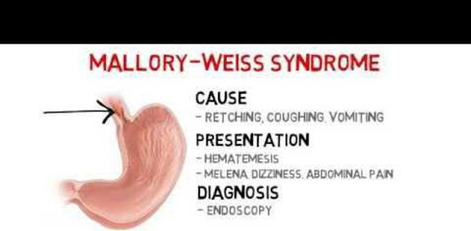 Some information about the Mallory weiss syndrome