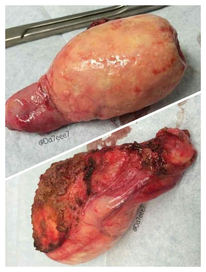 Porcelain gallbladder