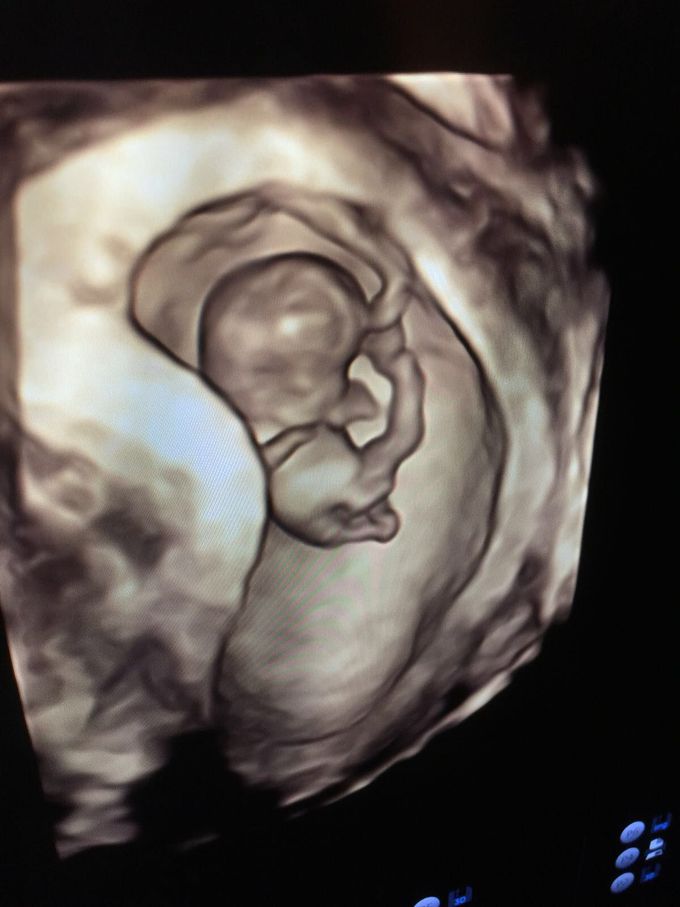 3D scan of a 9 week old fetus