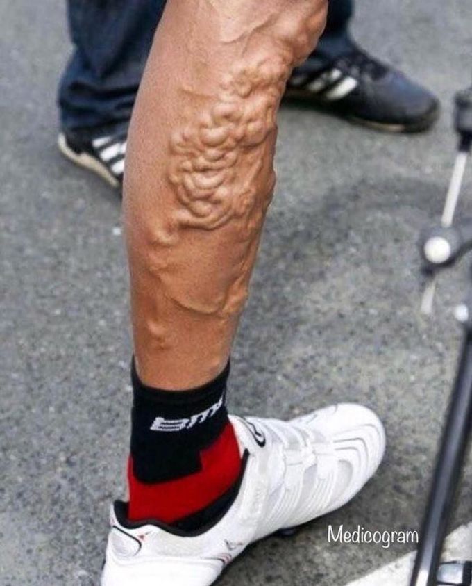 Varicose veins 