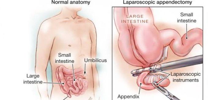 Treatment for Appendicitis