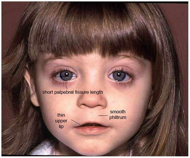 fetal alcohol syndrome facial features
