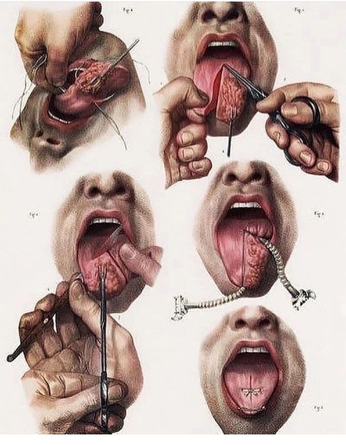 Cutting atongue without Anesthesia!