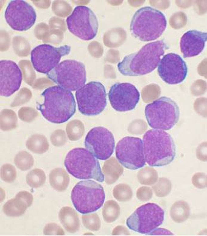 Acute Lymphoblastic Leukemia In children