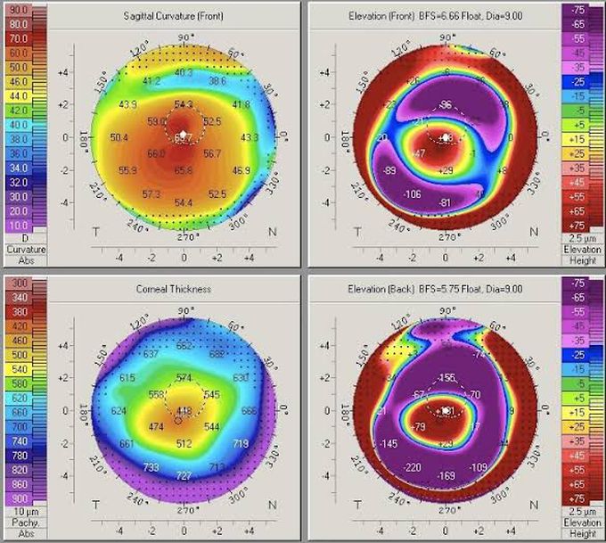 Keratoconus diagnosis