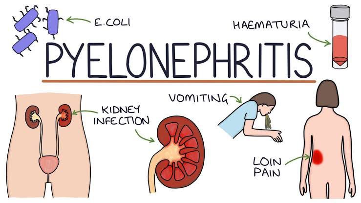 Symptoms Of Pyelonephritis Medizzy 3705