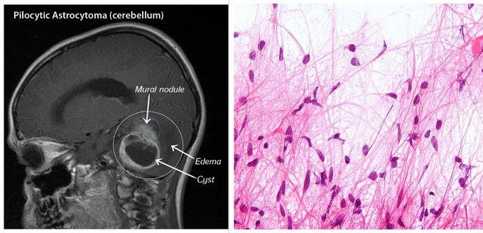 Pilocytic Astrocytoma: A Benign Neoplasm in Children