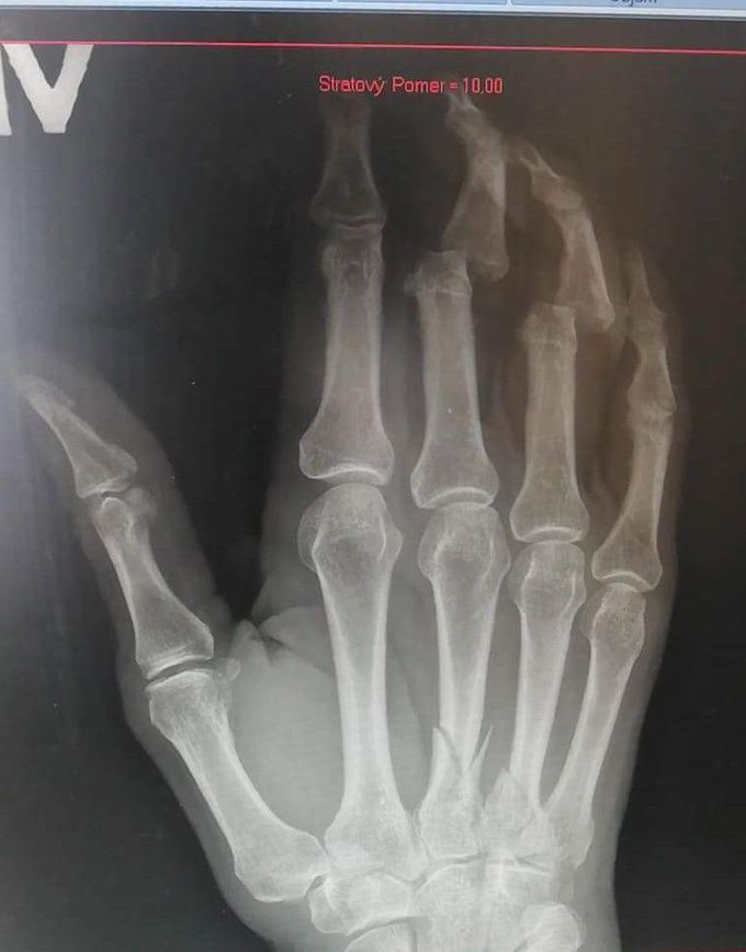 Little work injury... Fall from train