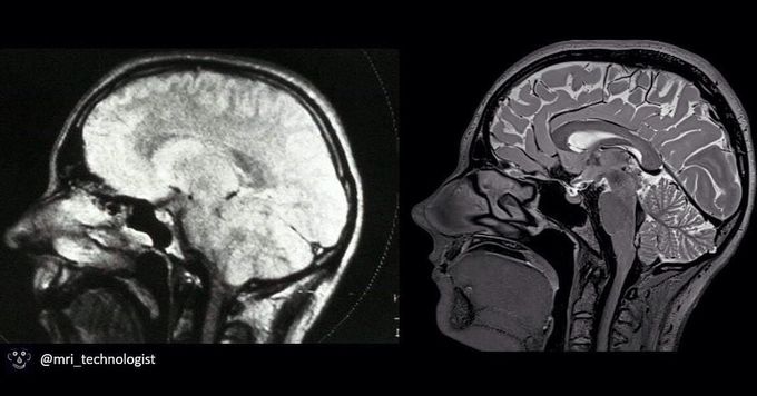 Early brain MRI scan from the 1980s