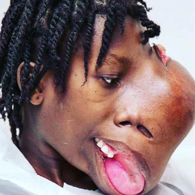 Face tumor