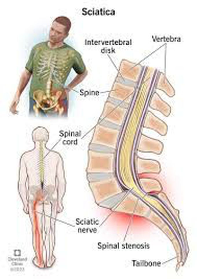 Lower Back Pain And Left Leg Pain