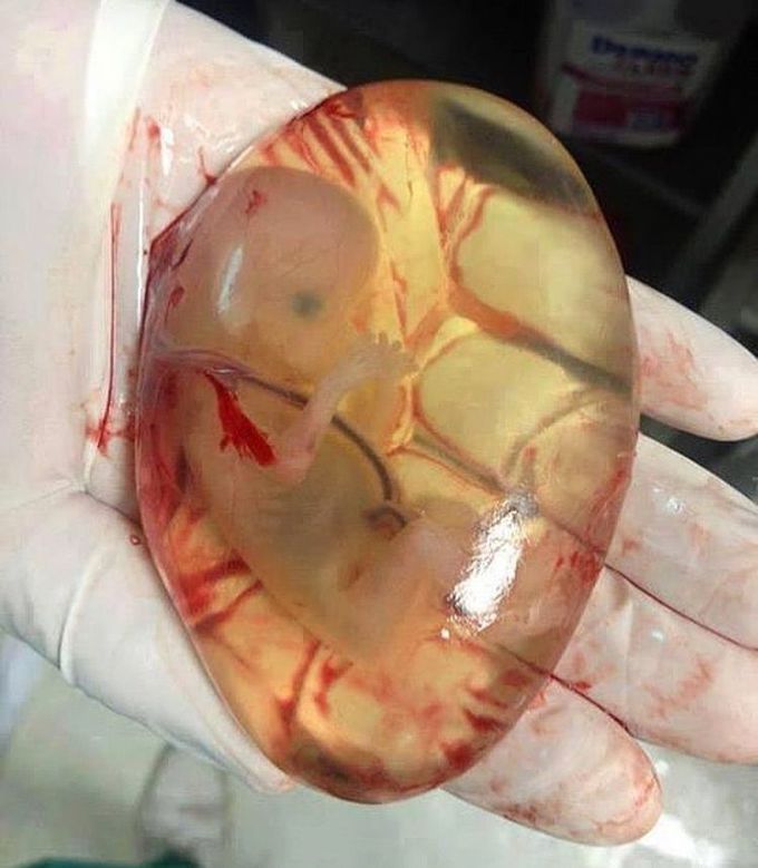 This is an underdeveloped fetus!!