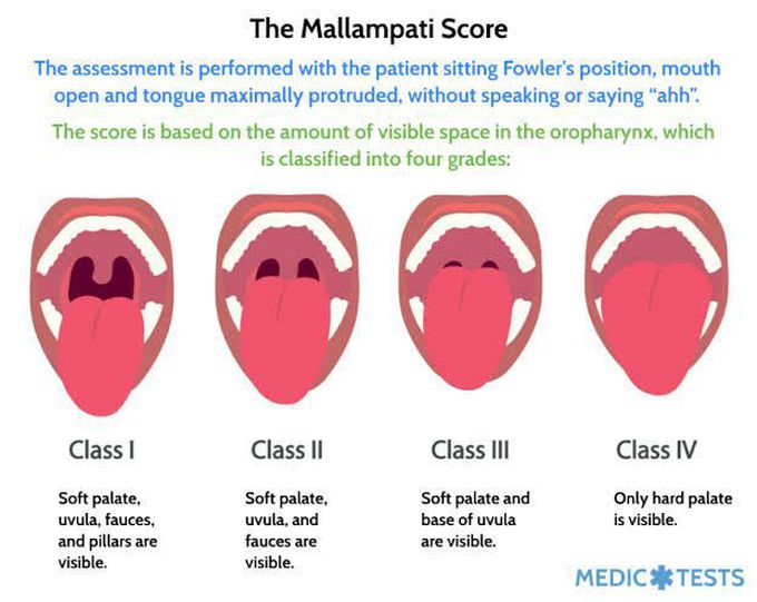 The Mallampati Score