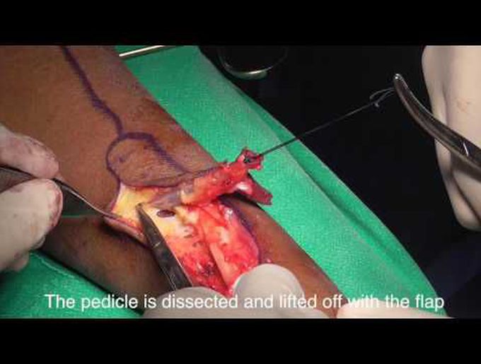 Shape modified radial forearm flap