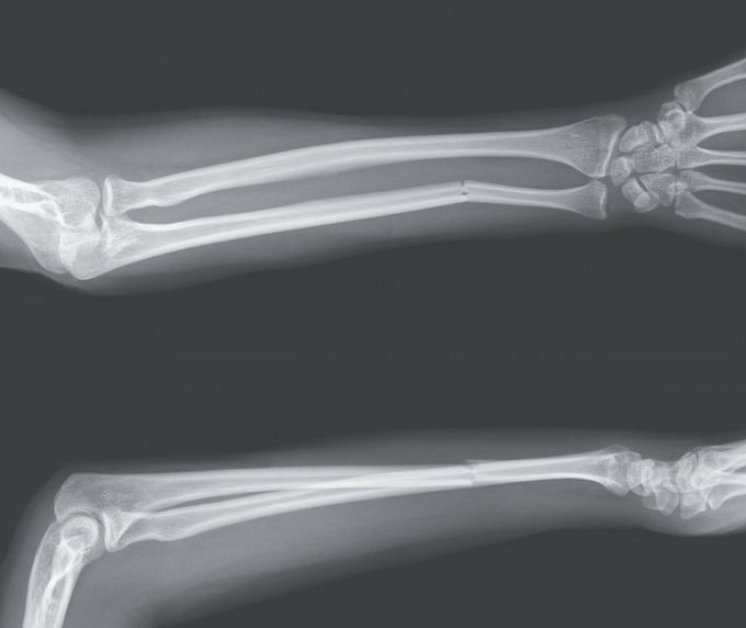 Isolated Ulnar Shaft Fracture