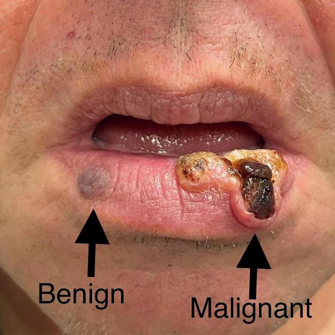 Lower Lip Cancer