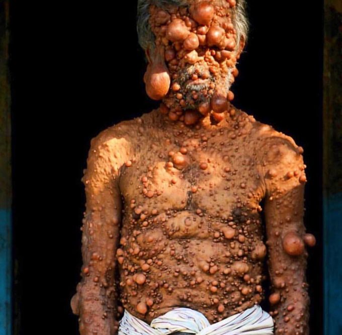 Neurofibromatosis