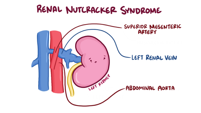 Nutcracker syndrome treatment