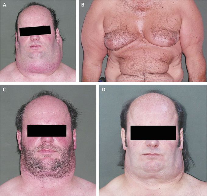 Madelung’s Disease