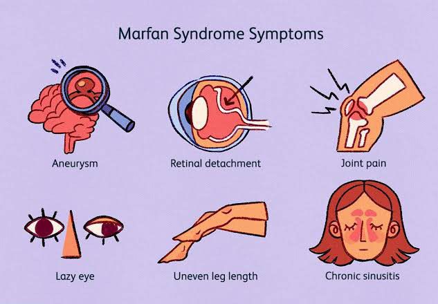 These are the symptoms of Marfan syndrome - MEDizzy