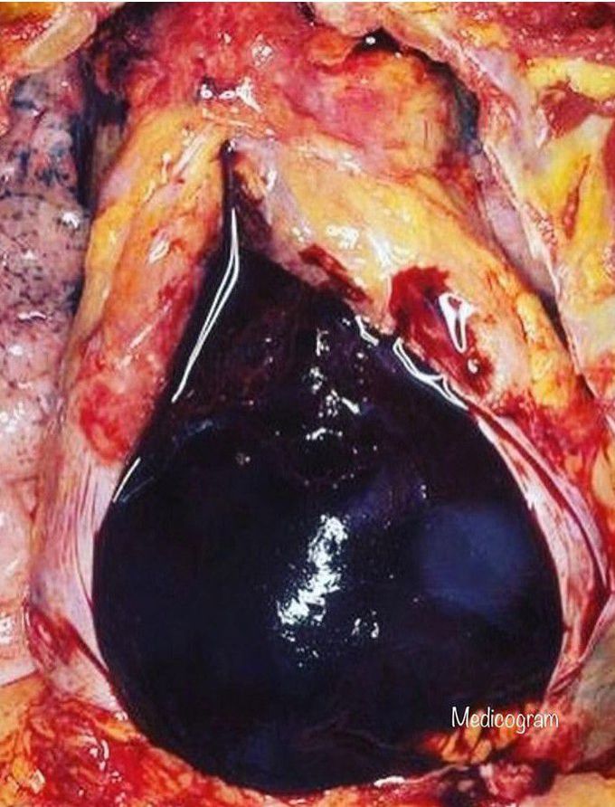 cardiovascular surgery