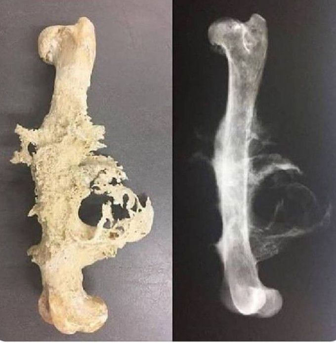 Osteosarcoma