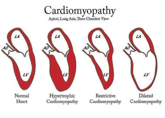 Cardiomyopathy