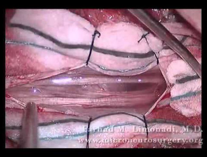 Spinal Tumor (Meningioma) Surgical Removal: Spine Surgery