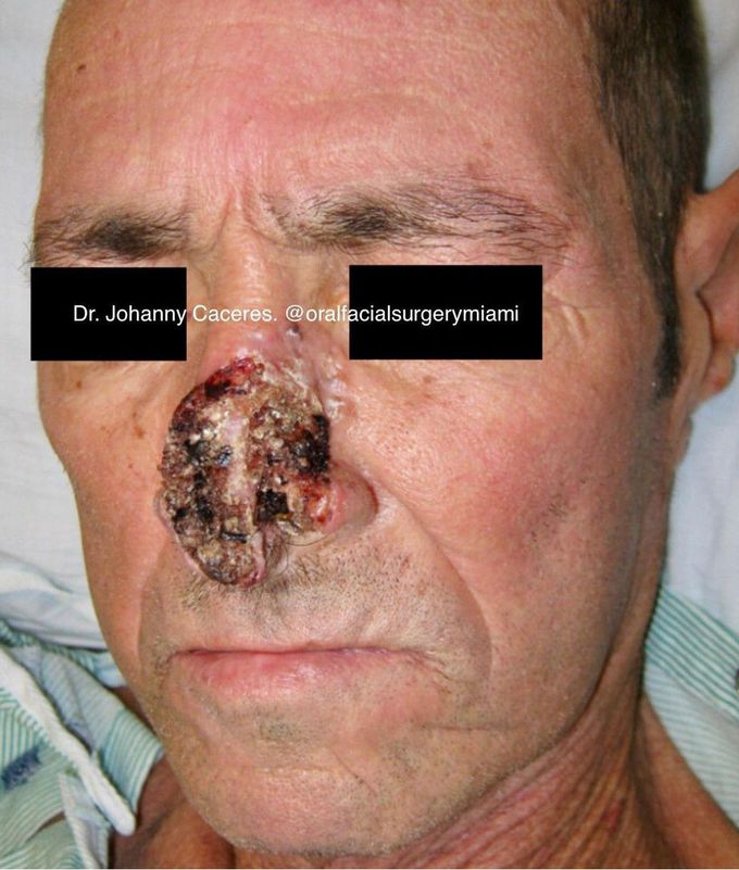 Advanced Squamous Cell Carcinoma