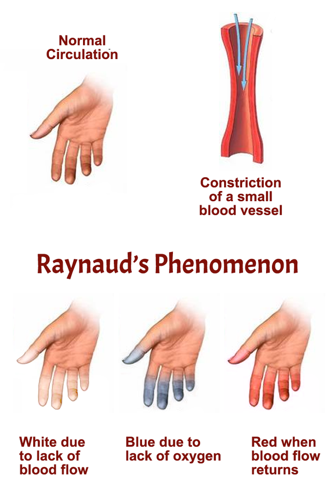 Types of Raynaud’s Phenomenon