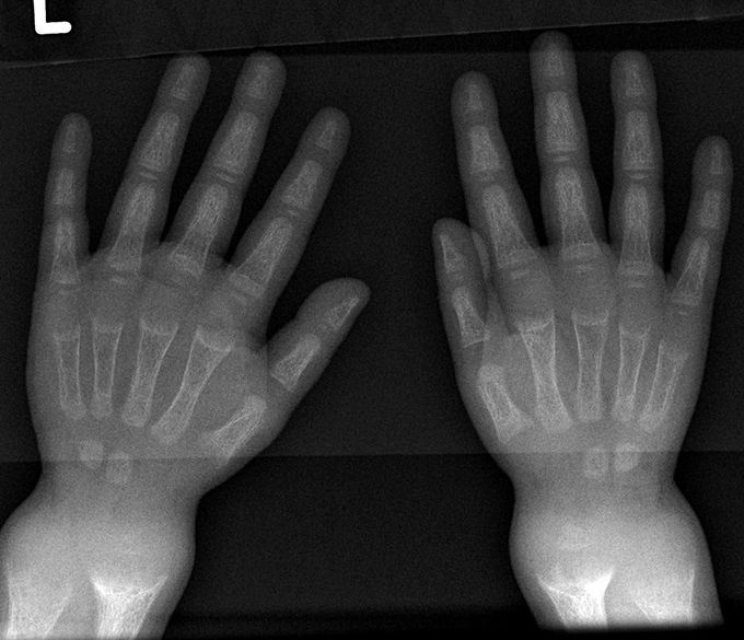 Name the deformity and the disease in which it occurs?