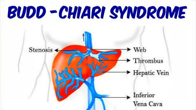 Budd Chiari Syndrome