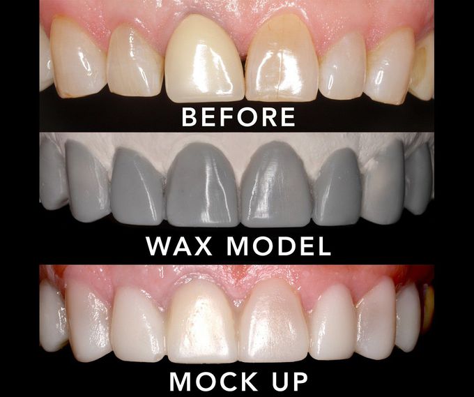 Dental Mock-up