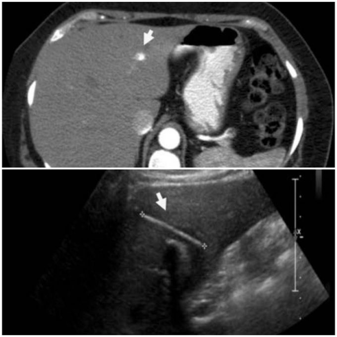 Toothpick in liver