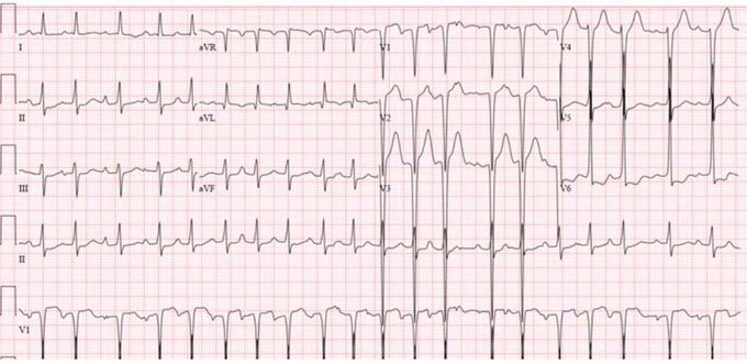 Ecg diagnosis