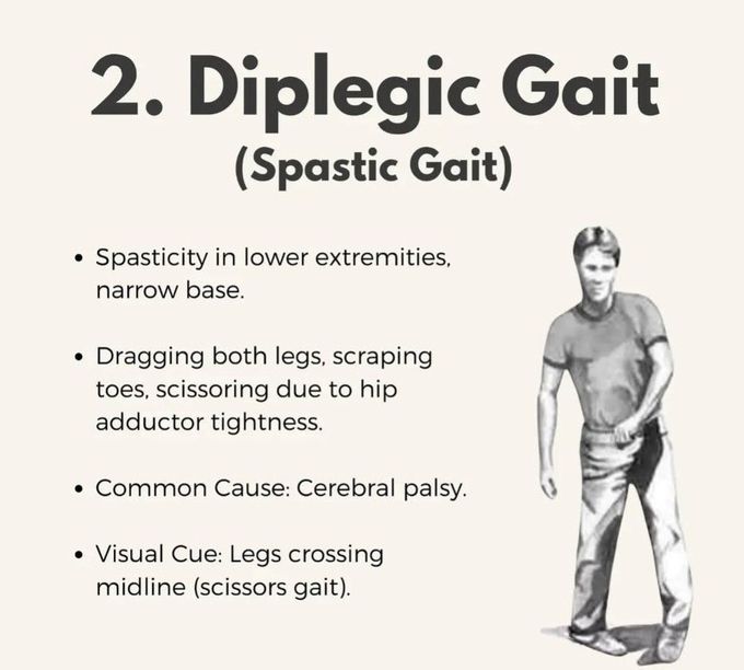 Diplegic Gait