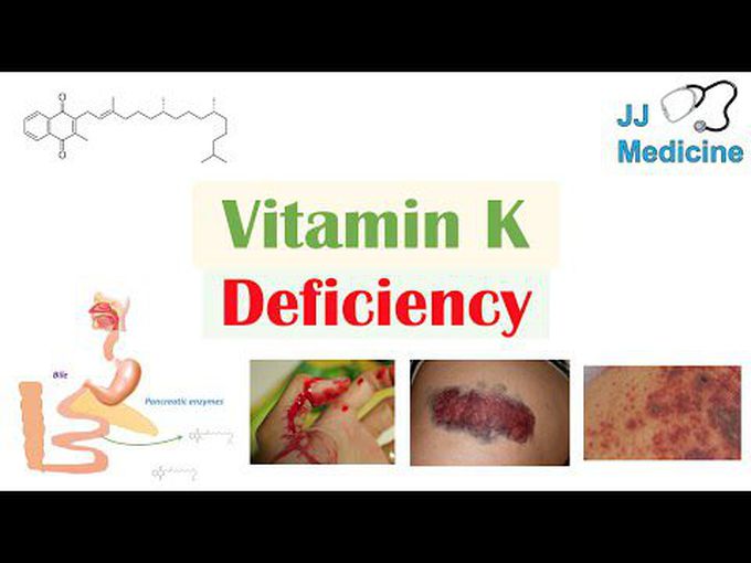 Vitamin K deficiency descriptively explained