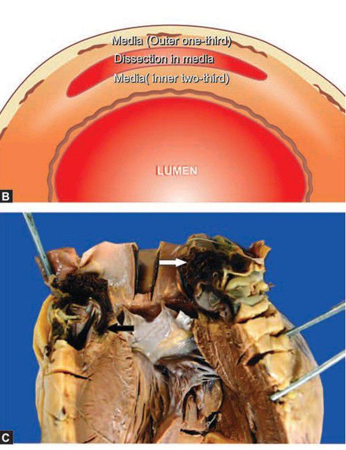 Dissecting aneurysm, (Type 1)