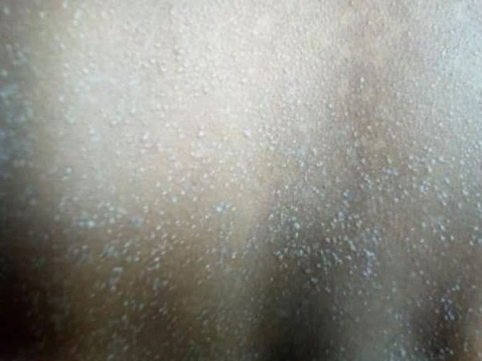 What is the skin problem?  Dx? Rx?