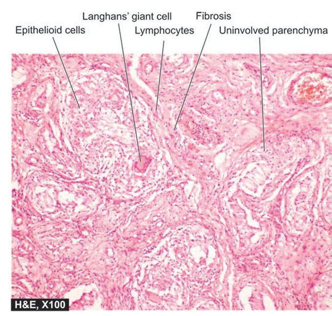 Tuberculous epididymo-orchitis.