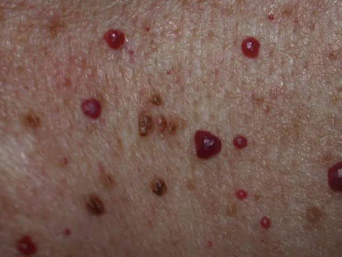 Cherry Angioma - MEDizzy