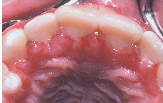 Acute Herpetic Gingivostomatitis