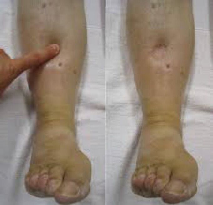 Pitting Edema