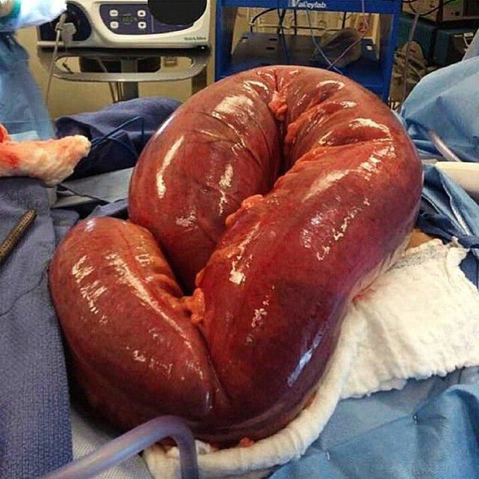 Megacolon